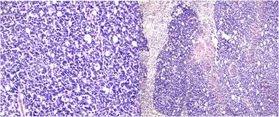 PDGF, NGF, and EGF as main contributors to tumorigenesis in high-risk retinoblastoma